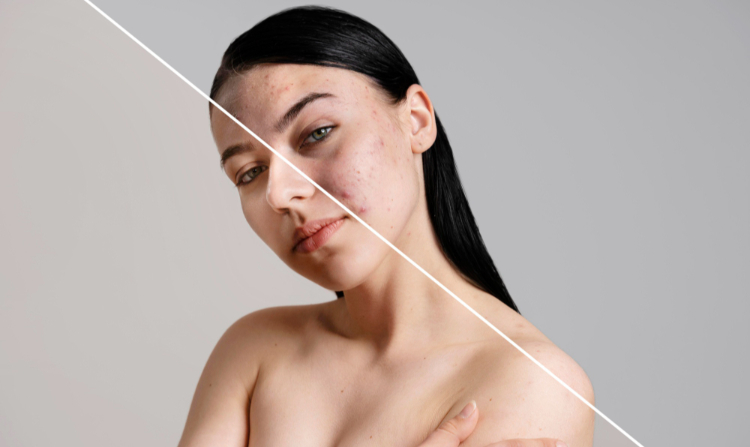 Sivilce İzleri İçin Çözüm Önerileri